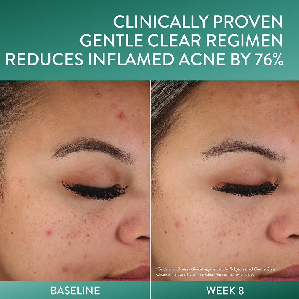 Cetaphil Face Moisturizer, Gentle Clear Mattifying Acne Moisturizer With 0.5% Salicylic Acid, Hydrates and Treats Sensitive Acne Prone Skin, Skin Care for Sensitive Skin, 3oz - 24hrsmart